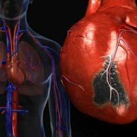 Что нельзя после инфаркта миокарда