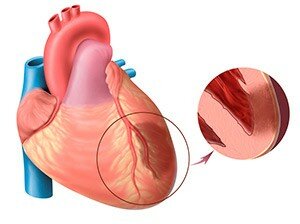 Гастралгическая форма инфаркта миокарда