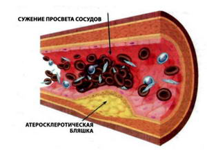 Атеросклероз кишечника