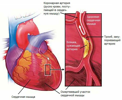 Инфаркт миокарда сердца