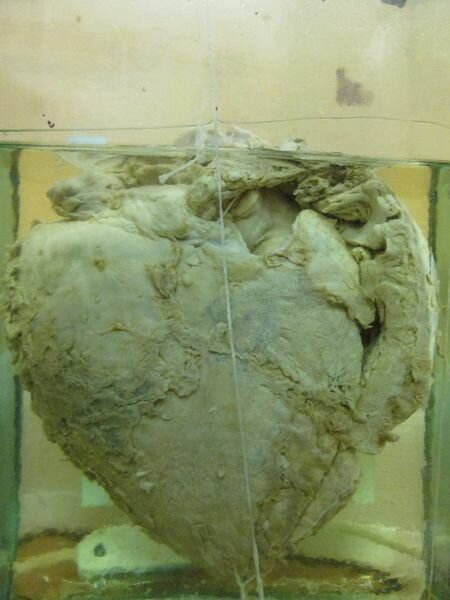 фиброзный перикардит области сердца