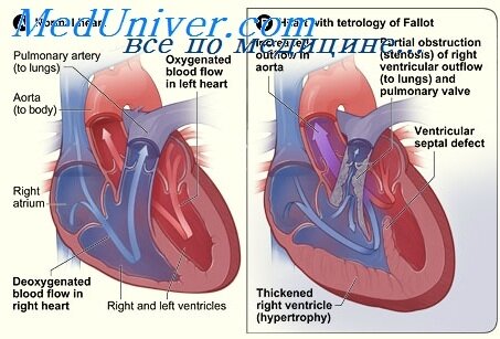 Дистилляционная кардиомиопатия