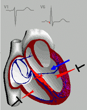 Локализация инфаркта миокарда по отведениям