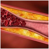 Эхографические признаки атеросклероза брахиоцефальных артерий