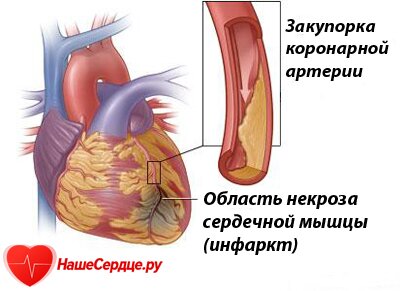Лечение и профилактика инфаркта миокарда
