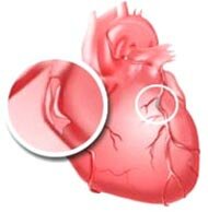 Ишемическая болезнь сердца причины возникновения