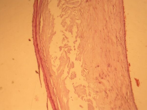 клинико морфологические формы атеросклероза почечных артерий
