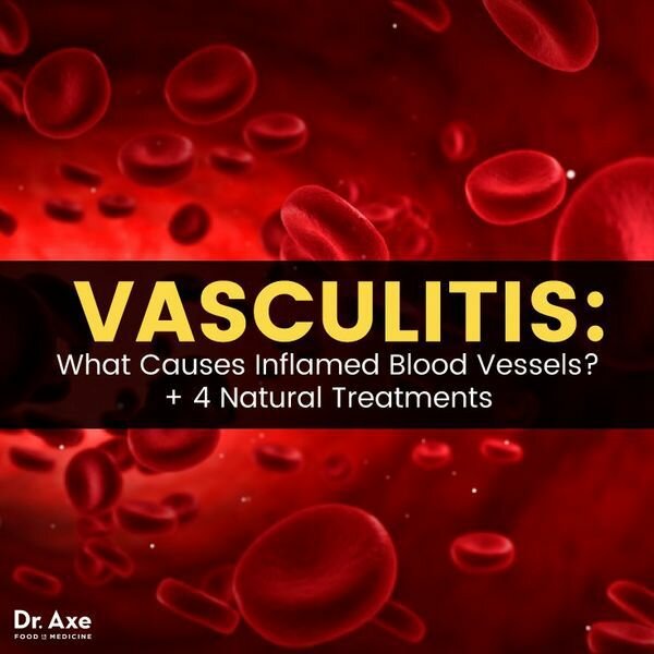 Васкулит: воспаленные кровеносные сосуды 4 естественные методы лечения