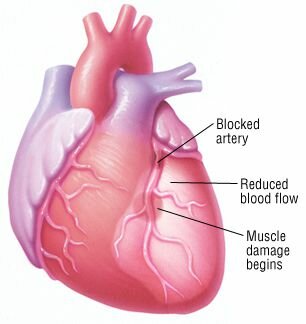 Сердечный приступ (инфаркт миокарда)