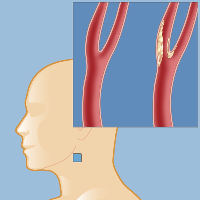 Стеноз устья вса. Атеросклероз сосудов брахиоцефальных артерий. Атеросклероз бляшка сонной артерии. Брахиоцефальные сосуды атеросклероз. Стеноз брахиоцефальных артерий.