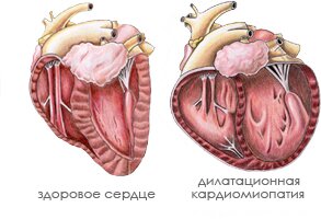 Причины симптомы и лечение неишемической кардиомиопатии