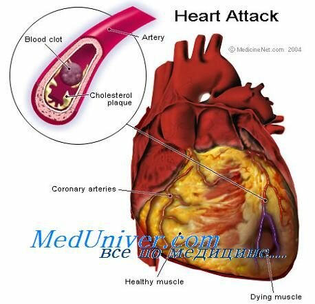 Сердечная астма и отек легких разница thumbnail