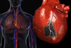 Обширный инфаркт миокарда симптомы ⋆ Лечение Сердца