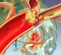 Системный тромболизис при остром инфаркте миокарда thumbnail