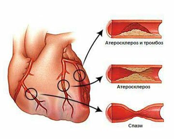 Атеросклероз и физические нагрузки