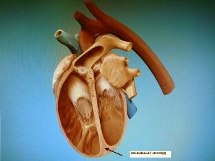 Ишемическая кардиомиопатия