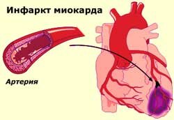 Признаки острого инфаркта миокарда