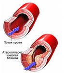 Атеросклероз верхних конечностей симптомы