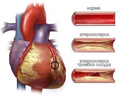 Сердечный атеросклероз