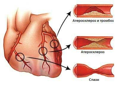 Атеросклероз интракраниальных артерий