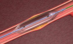 Ангиопластика и стентирование коронарных артерий