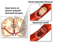 Диагностика атеросклероза сосудов головного мозга