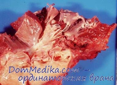 Эндокардит аортального клапана