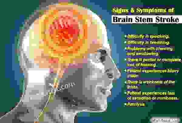 Инсульт мозга: лечение, продолжительность жизни, выздоровление, причины, симптомы, прогноз, реабилитация