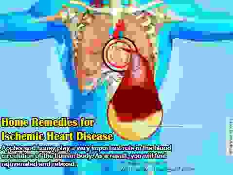 Ишемическая болезнь сердца: домашние средства, натуральные добавки, изменения образа жизни