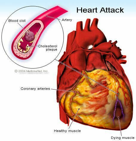 Симптомы сердечного приступа и признаки раннего предупреждения у женщин и мужчин