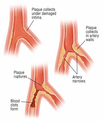 Артериосклероз артерий ног
