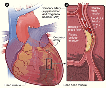 Что такое сердечный приступ, вызванный лекарственными препаратами?