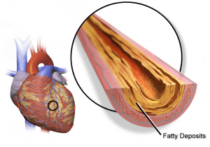 Инфаркт миокарда (сердечный приступ)