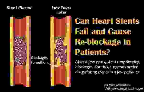 Может ли стенты сердца выйти из строя и вызвать повторную блокировку у пациентов