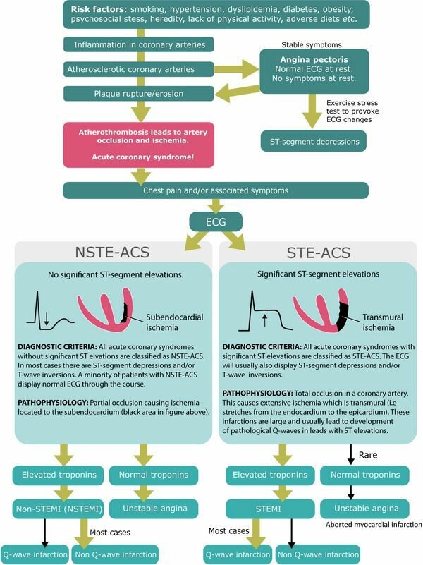 STEMI (инфаркт миокарда с подъемом сегмента ST): диагностика, критерии, ЭКГ - лечение
