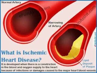 Ишемическая болезнь сердца: симптомы, причины, лечение и профилактика