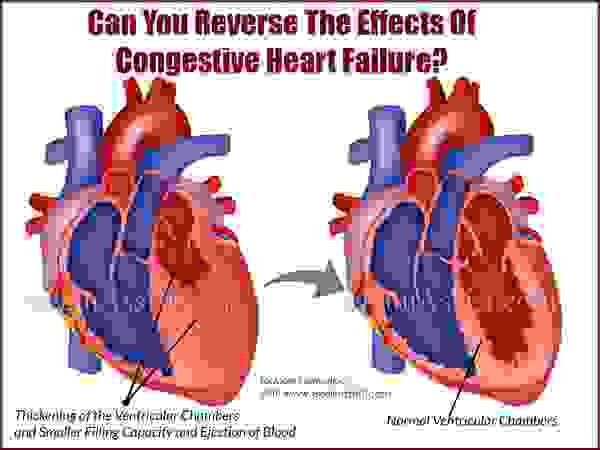 Можете ли вы обратить вспять последствия сердечной недостаточности