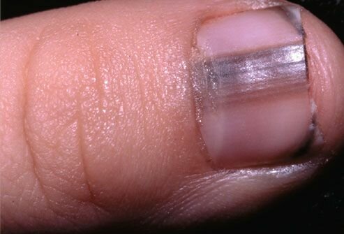 Слайд-шоу: что ваши ногти говорят о вашем здоровье