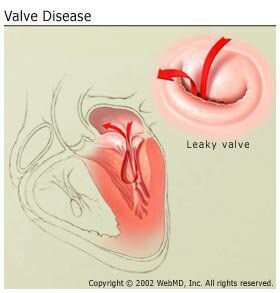 Болезнь сердца: болезнь сердечного клапана