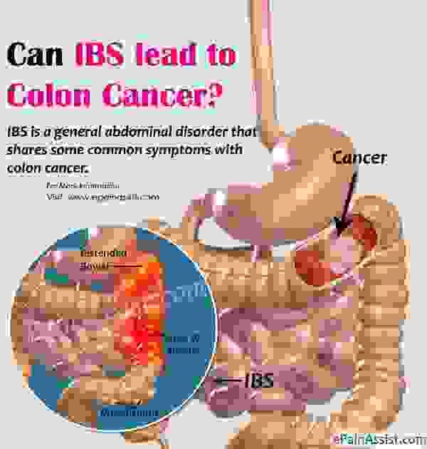 Может ли IBS привести к раку толстой кишки