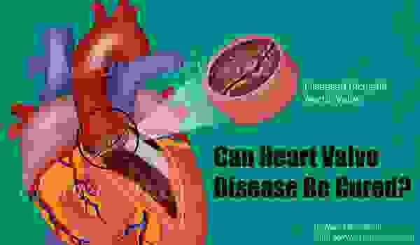 Можно ли вылечить болезнь сердечного клапана?