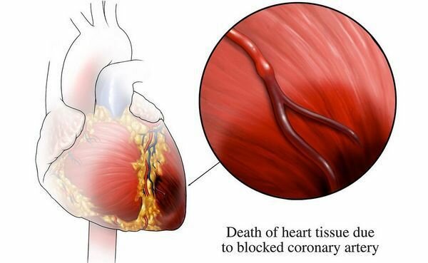 Типы инфаркта миокарда (ИМ) при медсестринском вмешательстве