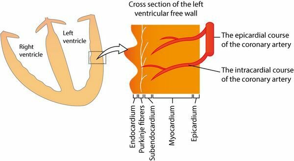 Классификация острых коронарных синдромов (ОКС) - острый инфаркт миокарда (ОИМ)