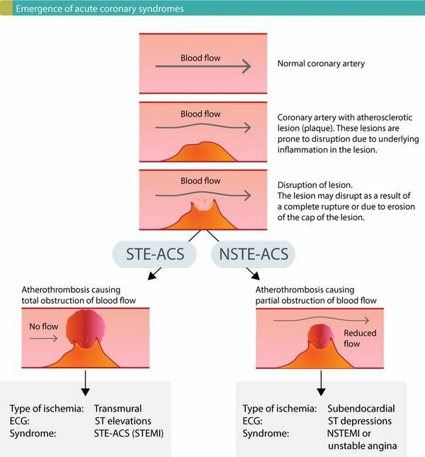 Классификация острых коронарных синдромов (ОКС) - острый инфаркт миокарда (ОИМ)