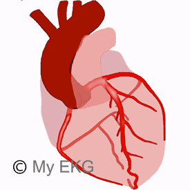 ЭКГ локализация окклюзированной артерии при остром инфаркте миокарда