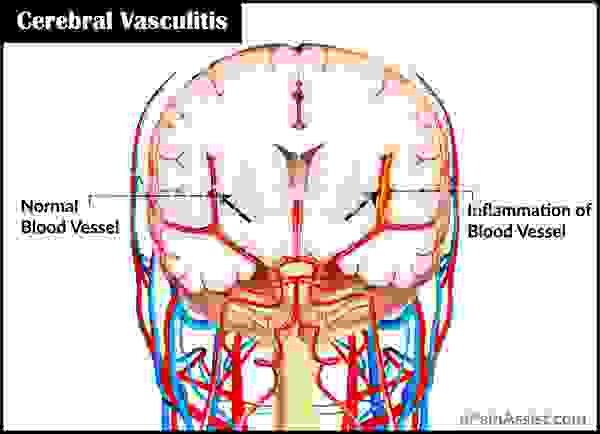 Церебральный васкулит: причины, симптомы, лечение, прогноз