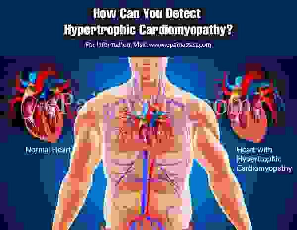 Как вы можете обнаружить гипертрофическую кардиомиопатию