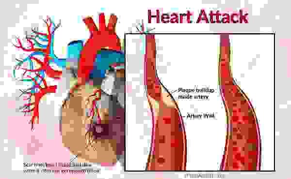 Сердечный приступ или инфаркт миокарда (ИМ): причины, факторы риска, симптомы, лечение